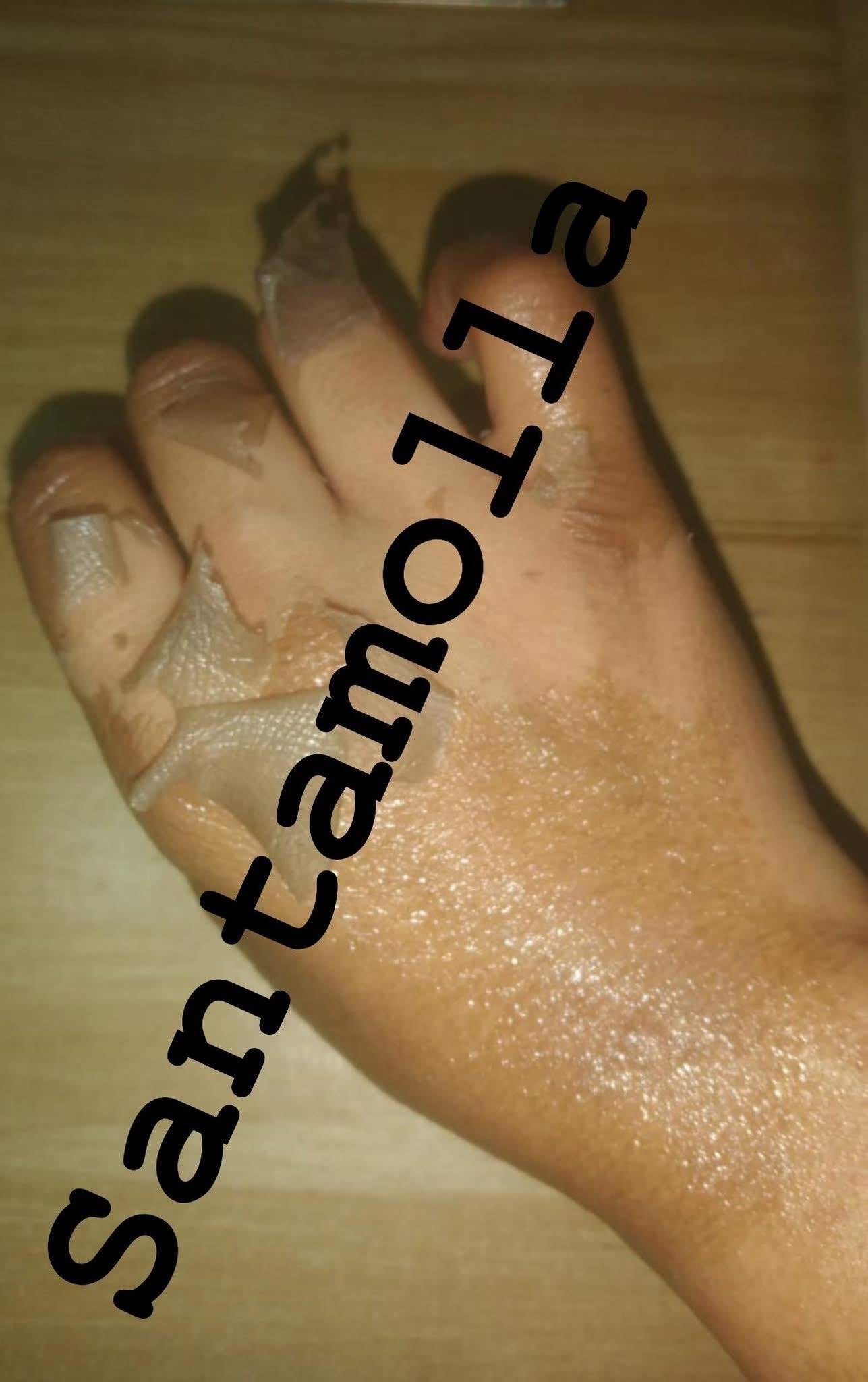 Santamolla peeling %25 مقشر لمناطق (الكوع .الركب .كف اليد . وش الرجل )