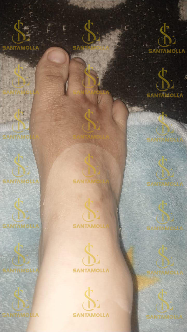 Santamolla peeling %25 مقشر لمناطق (الكوع .الركب .كف اليد . وش الرجل )