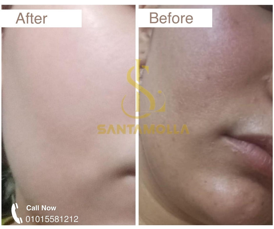 Santamolla peeling %15
